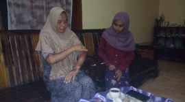 Siti Nurbaya, 40 tahun, korban pembakaran menunjukkan bekas luka bakar yang dideritanya. (Didik/SJ Foto)