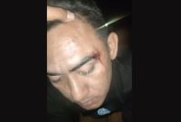 TERLUKA: Korban pemukulan Hamdi (Doc. Seputar Jatim)