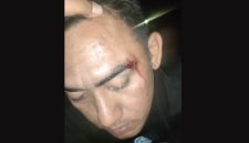 TERLUKA: Korban pemukulan Hamdi (Doc. Seputar Jatim)